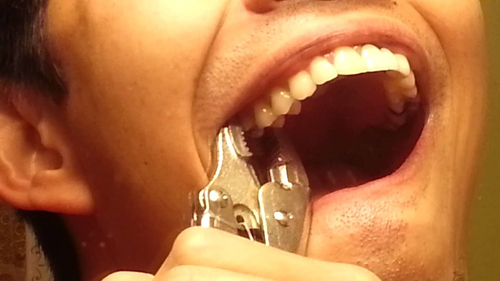 Không có tiền tới gặp nha sĩ, người đàn ông tự nhổ răng suốt 10 năm