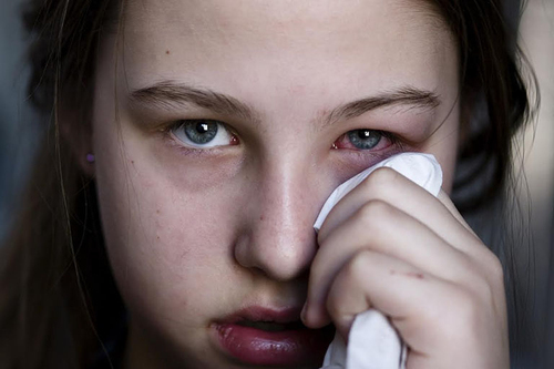Trán đau buốt, thị lực giảm vì viêm xoang 'hậu' cúm A