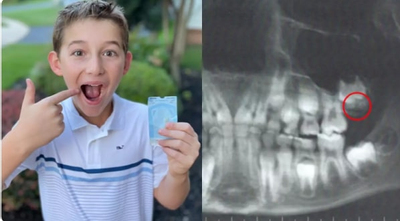 Hi hữu cậu bé 9 tuổi nhổ bỏ răng khôn mọc lệch, ghi tên vào sách kỷ lục