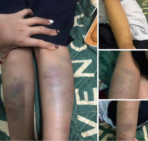 Đà Nẵng: Công an quận điều tra vụ học sinh lớp 1 bị đánh bầm tím