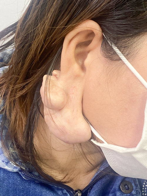 U40 choáng váng khi phải cắt bỏ tai chỉ vì cách làm đẹp phổ biến