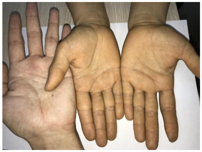 Hai mẹ con mặt vàng như nghệ do món bổ mắt, sáng da