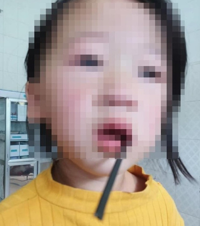 Nghệ An: Bé gái 4 tuổi bị thanh sắt đâm xuyên miệng
