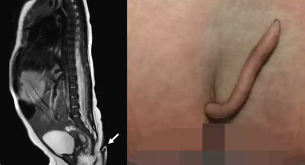 Bé gái chào đời với chiếc đuôi dài 5 cm cực hiếm