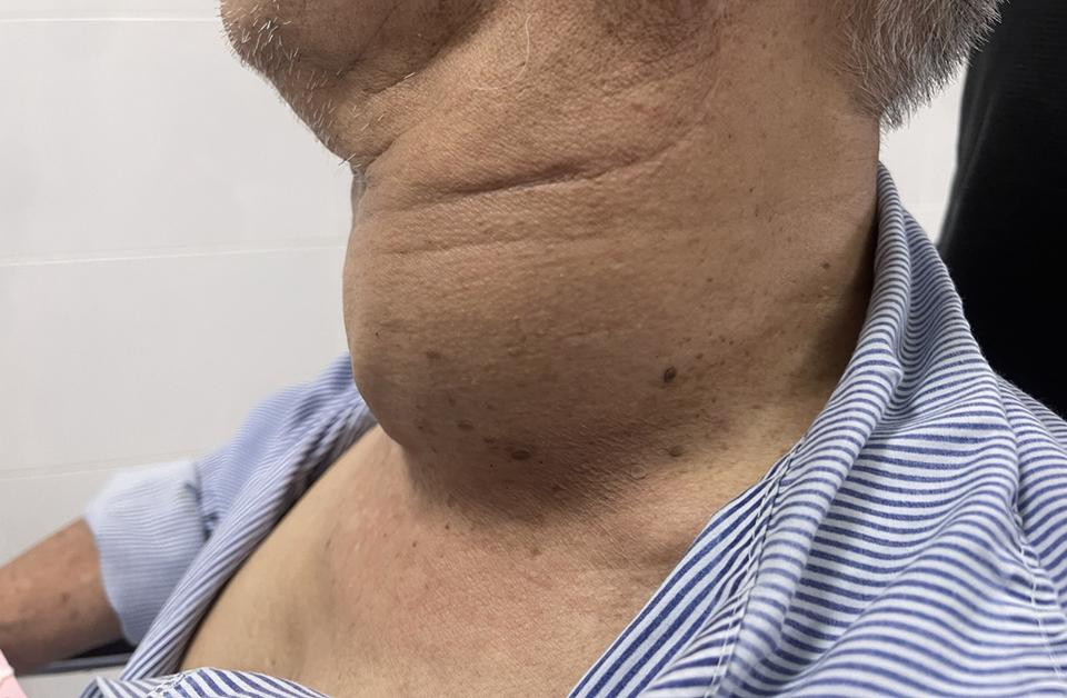 Mất giọng, khó ăn uống, bác sĩ lấy ra vật này từ cổ cụ ông