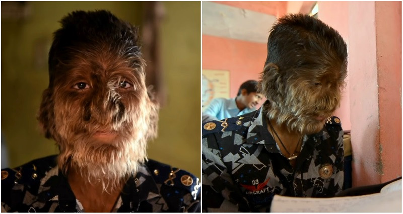 Nỗi khổ của chàng trai được mệnh danh là ‘người sói’