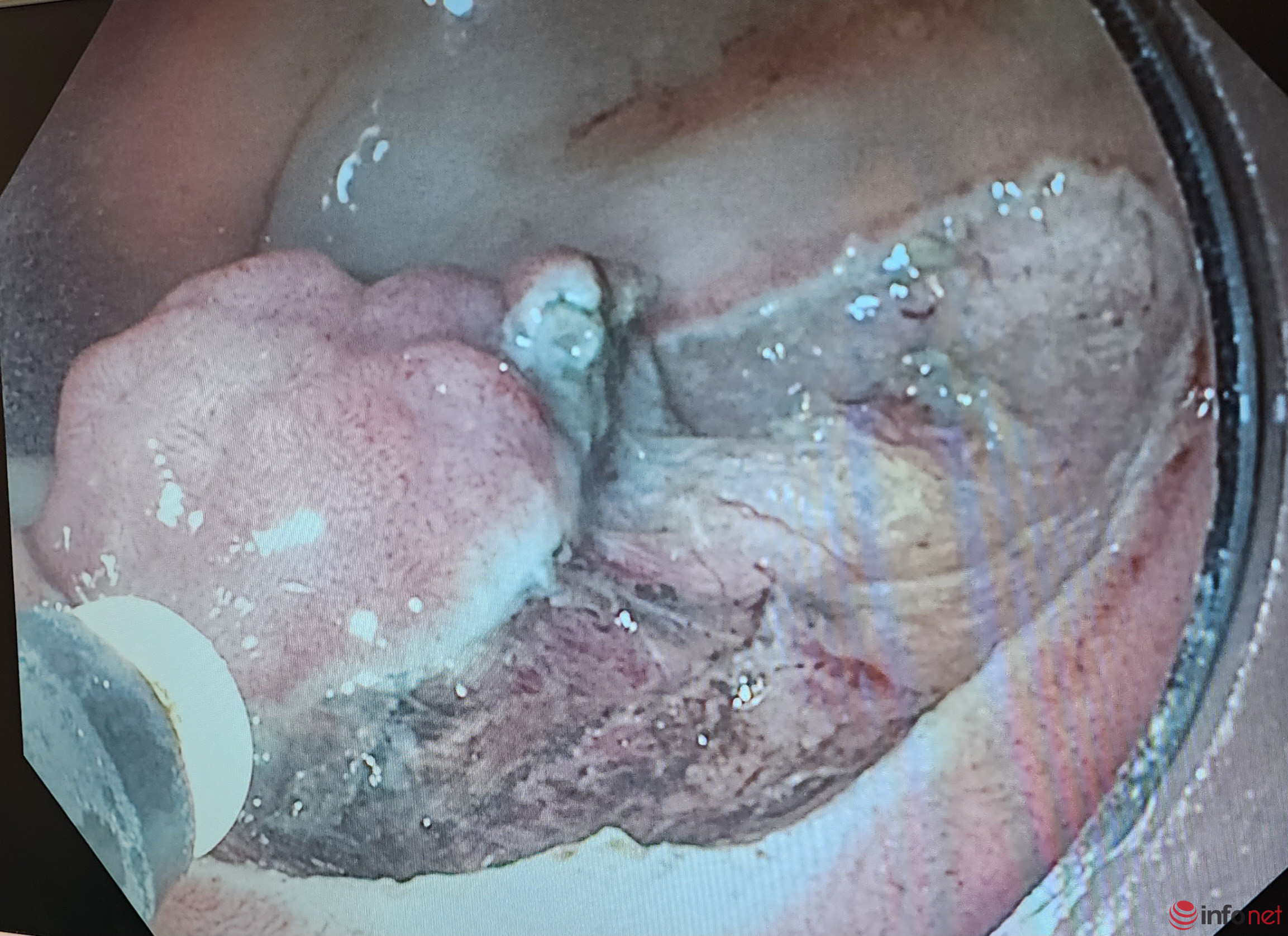 Xử lý polyp ung thư hoá trực tràng sớm, không hóa trị