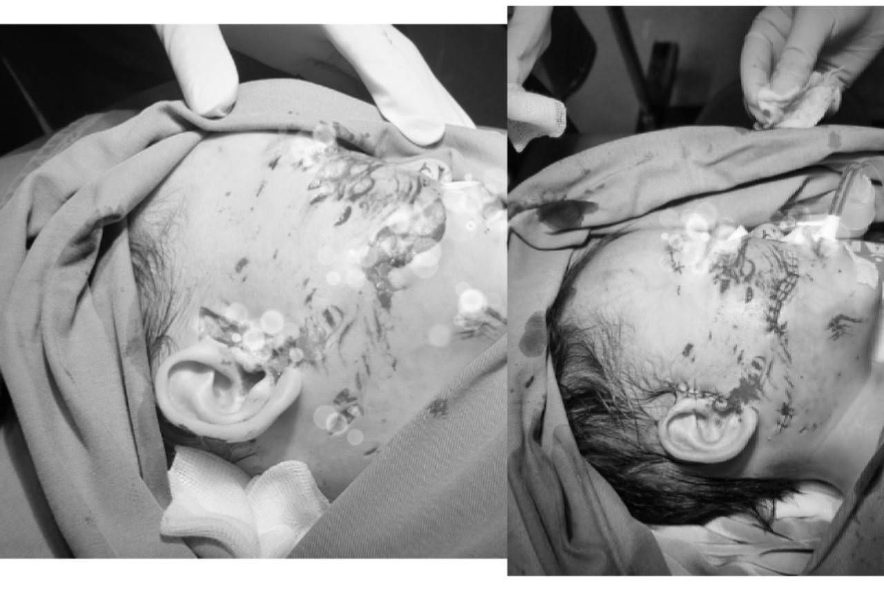 Bé trai 2 tuổi bị chó cắn trọng thương vùng mặt, đầu