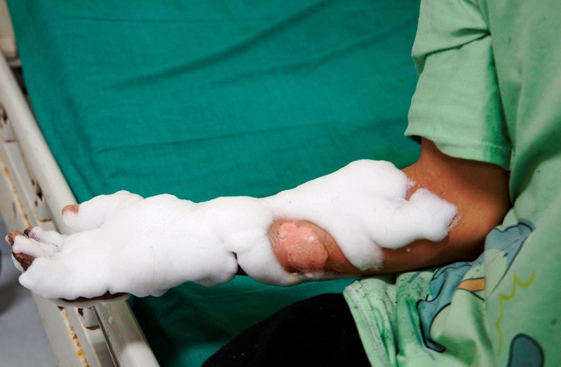 Bỏng nặng do điện thoại phát nổ khi vừa dùng vừa sạc