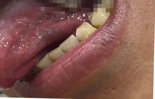 40 tuổi đã phải cắt lưỡi, bác sĩ chỉ ra dấu hiệu dễ nhầm với nhiệt miệng