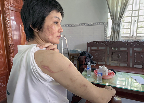 Người phụ nữ mang bầu 7 tháng bị chồng bạo hành dã man