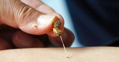 Kỳ lạ cách thầy lang chữa bệnh: Cho ong đốt khắp người