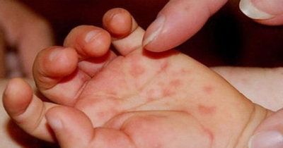 Bộ Y tế: 40% trẻ mắc tay chân miệng do chủng virus nguy hiểm