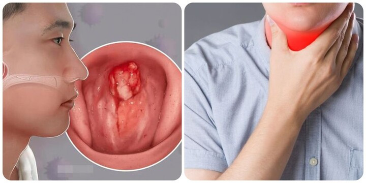 Ung thư vòm họng thường được phát hiện nhiều ở người có lối sống không lành mạnh và tiền sử gia đình mắc bệnh