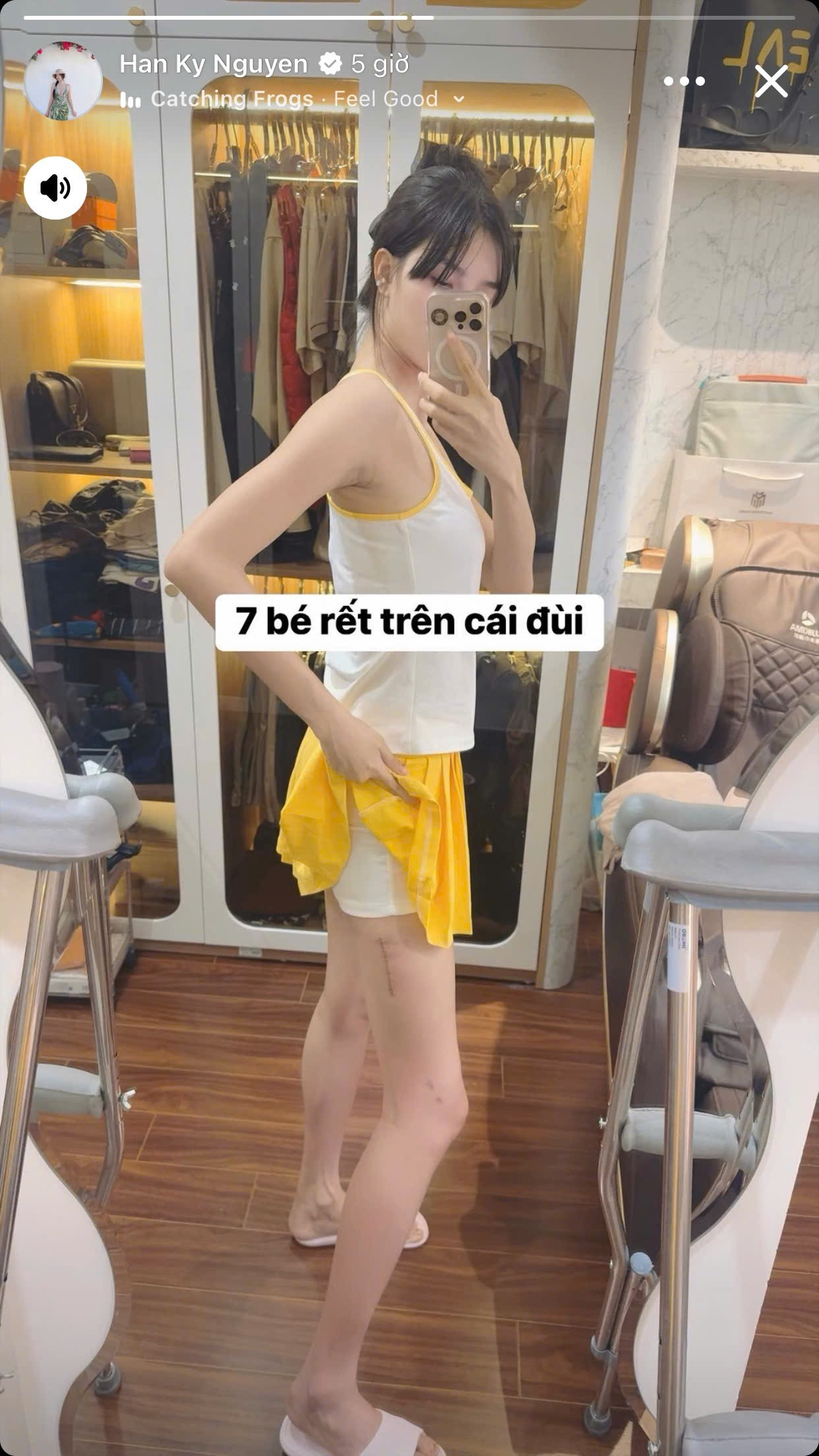 Vợ Mạc Hồng Quân catwalk trở lại sau 6 tháng gãy đùi bị soi đôi chân con rết kém thẩm mỹ