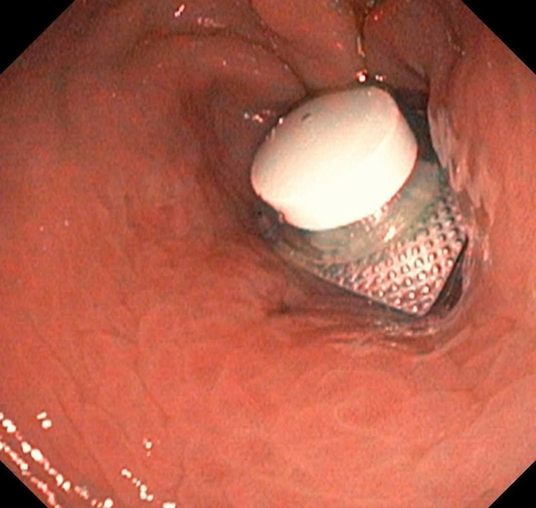 Người đàn ông đau bụng nhập viện cấp cứu, bác sĩ phát hiện lý do ít ai ngờ tới, nuốt nhầm vỏ thuốc.jpg