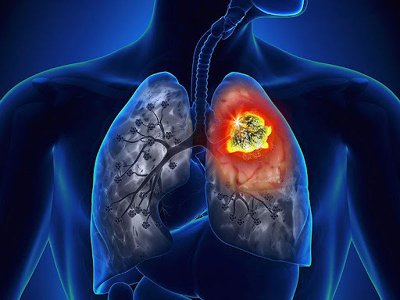 Người phụ nữ 60 tuổi bị ung thư phổi cố kìm nước mắt chia sẻ Bàn tay đã có vấn đề từ sớm nhưng không chú trọng