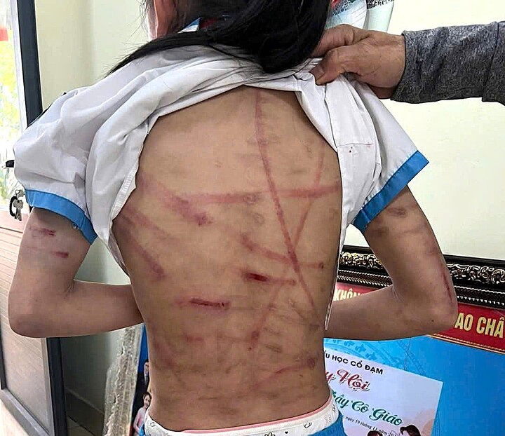 Toàn thân em H.T.N.L đầy vết thâm đỏ do bị đánh đập