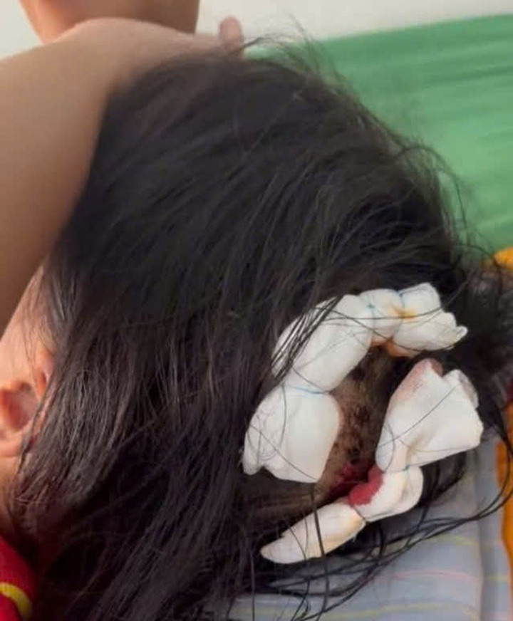Trên đầu em H.T.N.L. cũng có nhiều vết thương.