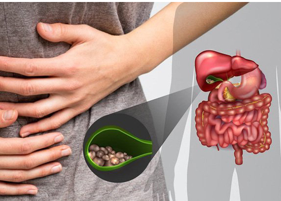 Đi khám vì đau bụng, bác sĩ lấy ra 30 viên sỏi mật trong người bệnh nhân 31 tuổi - Ảnh 2.
