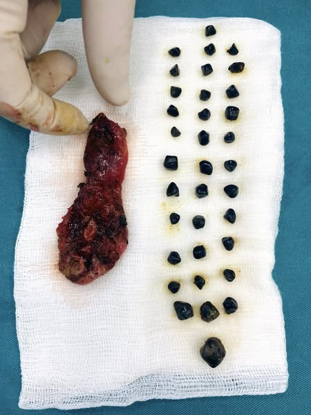 Đi khám vì đau bụng, bác sĩ lấy ra 30 viên sỏi mật trong người bệnh nhân 31 tuổi  - Ảnh 1.