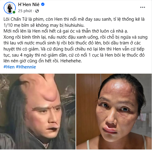 HHen Niê phát hoảng vì mặt sưng phù đến biến dạng chuyện gì đây