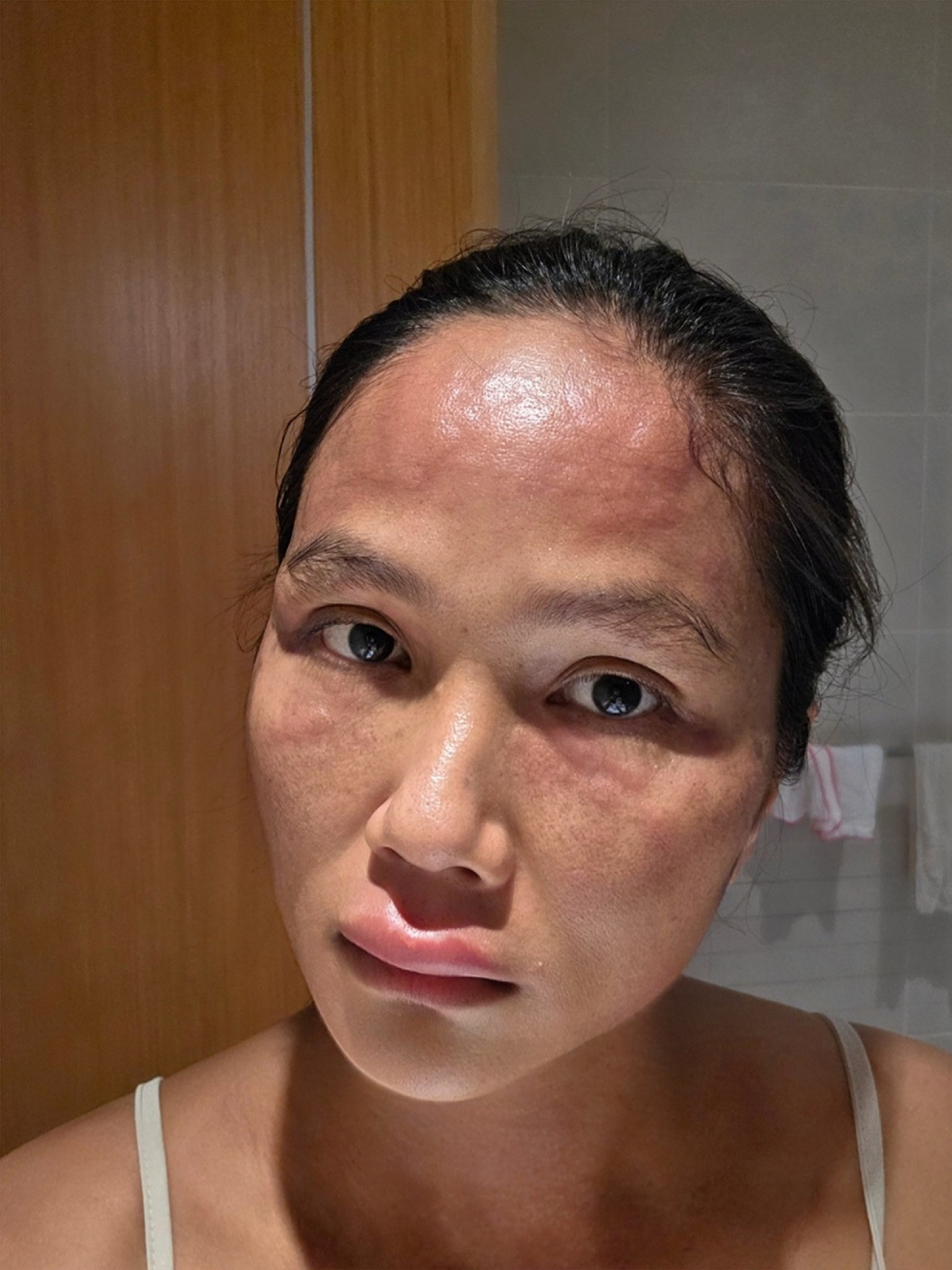 HHen Niê phát hoảng vì mặt sưng phù đến biến dạng chuyện gì đây