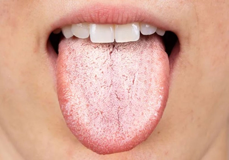 Lưỡi cho biết bạn khỏe mạnh hay không 3 thay đổi có thể cho thấy gan hoặc dạ dày đang kêu cứu