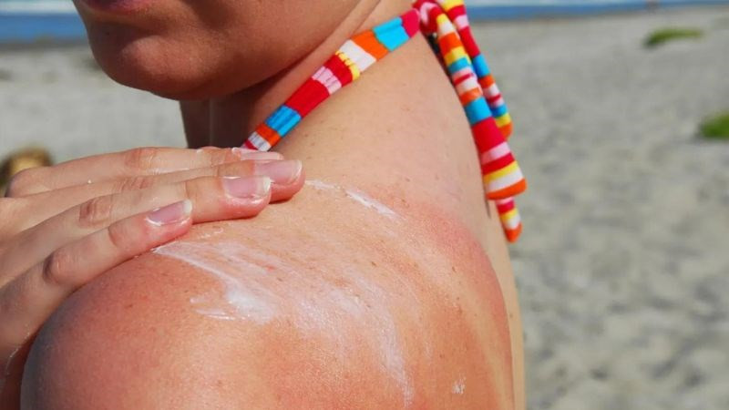 Tác hại của việc không dùng kem chống nắng - Ảnh 1.