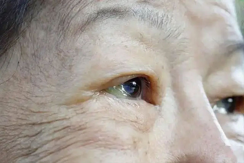 Bác sĩ cảnh báo Người thận yếu khi uống nước sẽ có 3 dấu hiệu bất thường