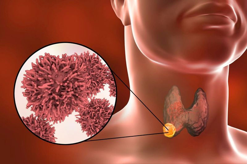 Lo lắng nhân giáp biến đổi ung thư Cảnh giác với 4 triệu chứng cơ thể sau đây