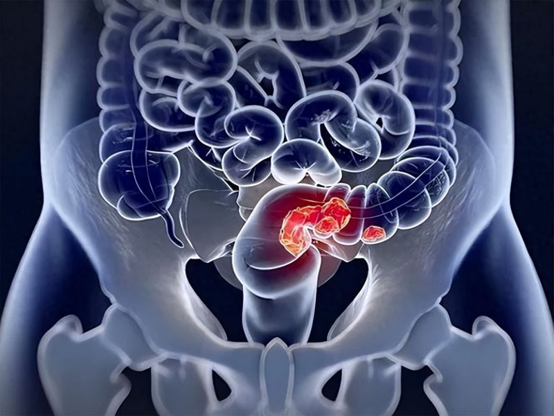 Đi ngoài ra máu có thể là ung thư trực tràng không phải trĩ Xuất hiện 4 dấu hiệu này cần đi khám ngay