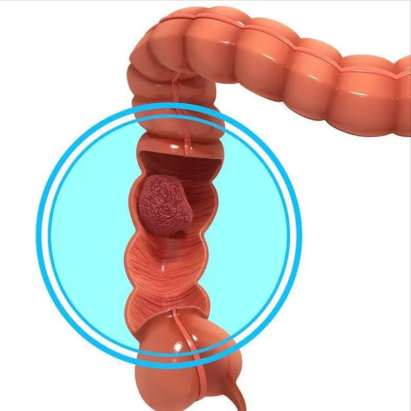 Đi ngoài ra máu có thể là ung thư trực tràng không phải trĩ Xuất hiện 4 dấu hiệu này cần đi khám ngay