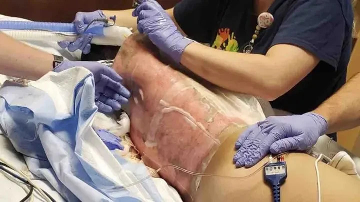 Năm 2023, thiếu niên Corey Lee ở Arizona bị bỏng hơn một nửa cơ thể sau khi tham gia thử thách ném quả cầu lửa. (Ảnh: GoFundMe)