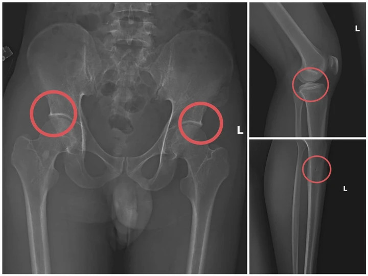 Bản phim chụp XQ một số tổn thương xương do đối tượng tạo ra. (Ảnh: Công an tỉnh Phú Thọ).