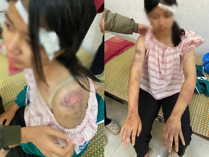 Những vết bầm tím trên cơ thể cháu P.A.