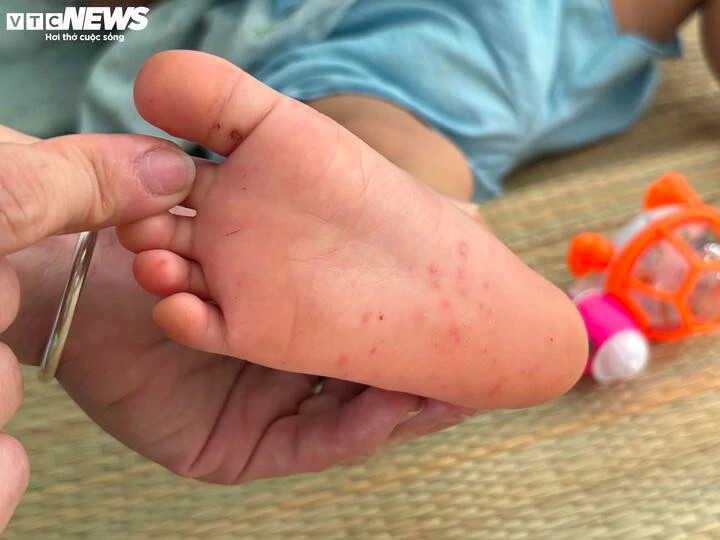 Phát ban, nổi mụn nước là những dấu hiệu khởi phát bệnh tay chân miệng.