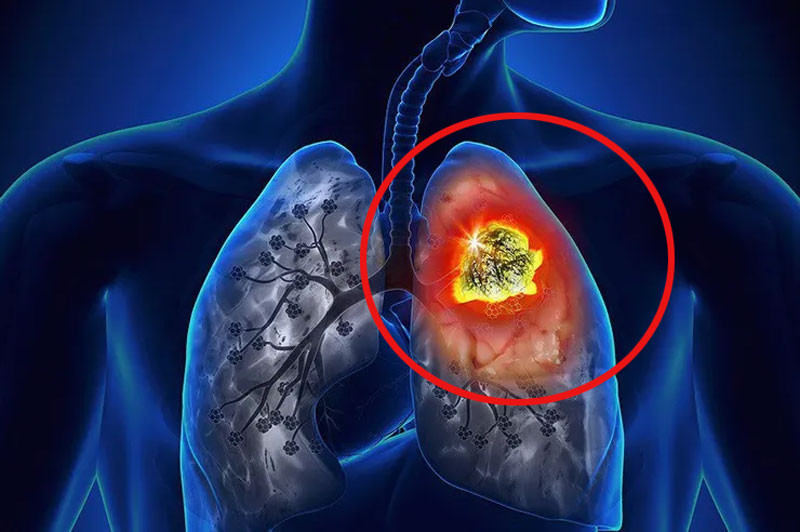 Nếu xuất hiện dấu hiệu này trên bàn tay rất có thể bạn đã bị ung thư phổi Những người từ 4070 tuổi đừng bỏ qua