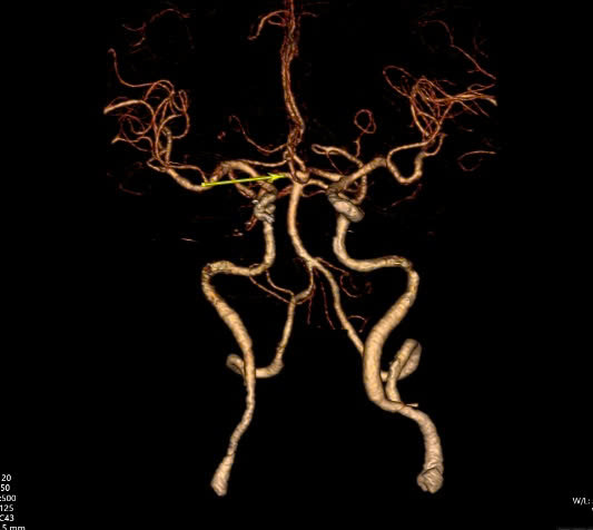 Liên tiếp 3 người đàn ông phát hiện phình mạch máu não: Dấu hiệu nguy hiểm nhưng nhiều người Việt bỏ qua - Ảnh 1.