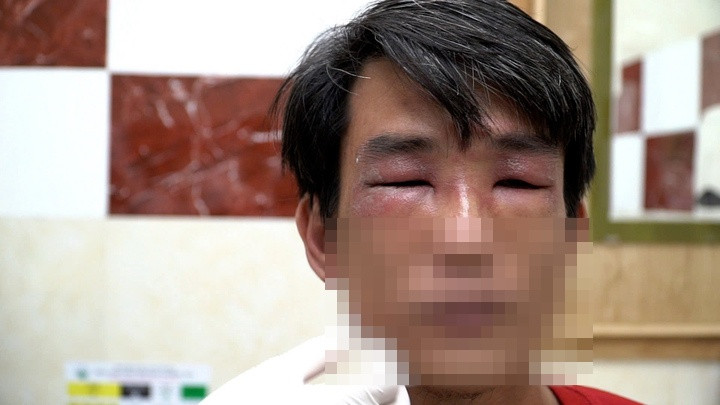 Cảnh báo tình trạng kiến ba khoang tấn công nhiều người ở TP HCM - Ảnh 1.