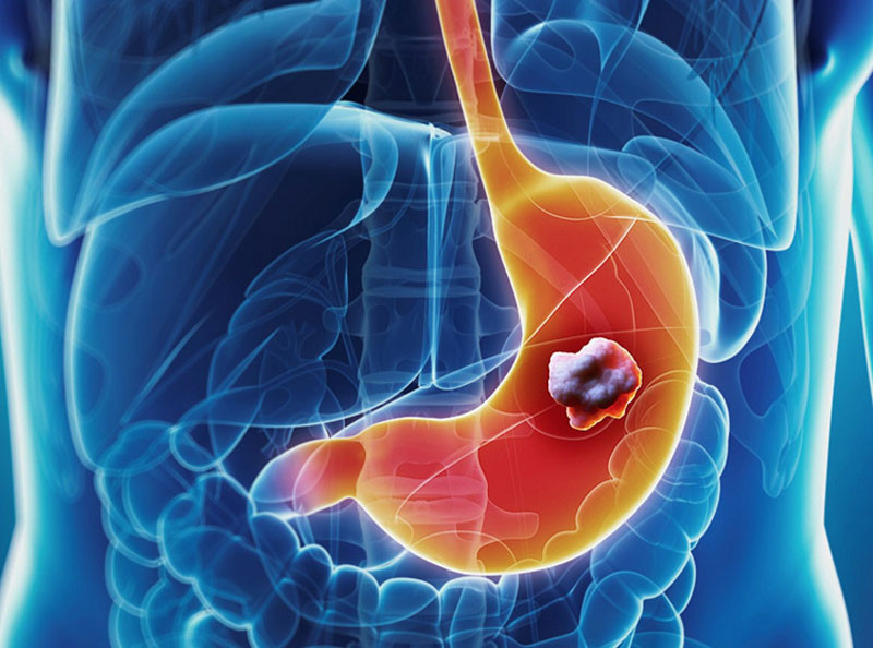 Ung thư dạ dày cách bạn chỉ qua 3 thói quen bác sĩ nhắc nhở 90 có thể phòng ngừa