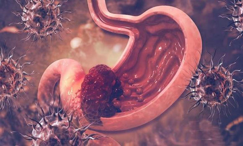 Không phải tự nhiên bị ung thư dạ dày Nghiên cứu phát hiện người mắc bệnh liên quan đến 5 điều sau