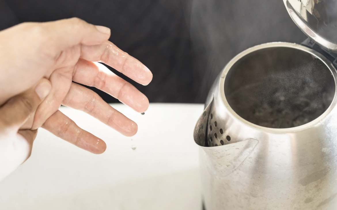 Bé 9 tháng tuổi bỏng 30% cơ thể do kéo dây ấm siêu tốc - Ảnh 1.