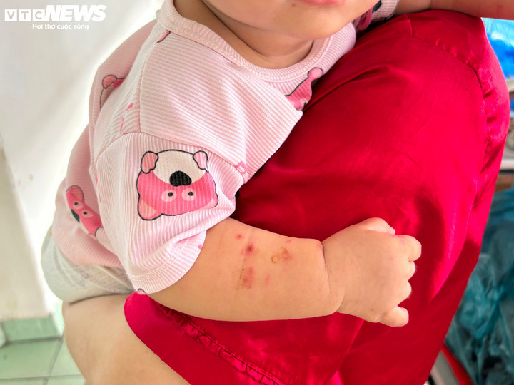 Nhiều trẻ mắc tay chân miệng trở nặng do tác nhân EV71, bác sĩ khuyến cáo gì?- Ảnh 1.