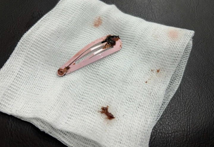 Kẹp tóc dài 7cm được gắp ra ngoài. (Ảnh: BV)