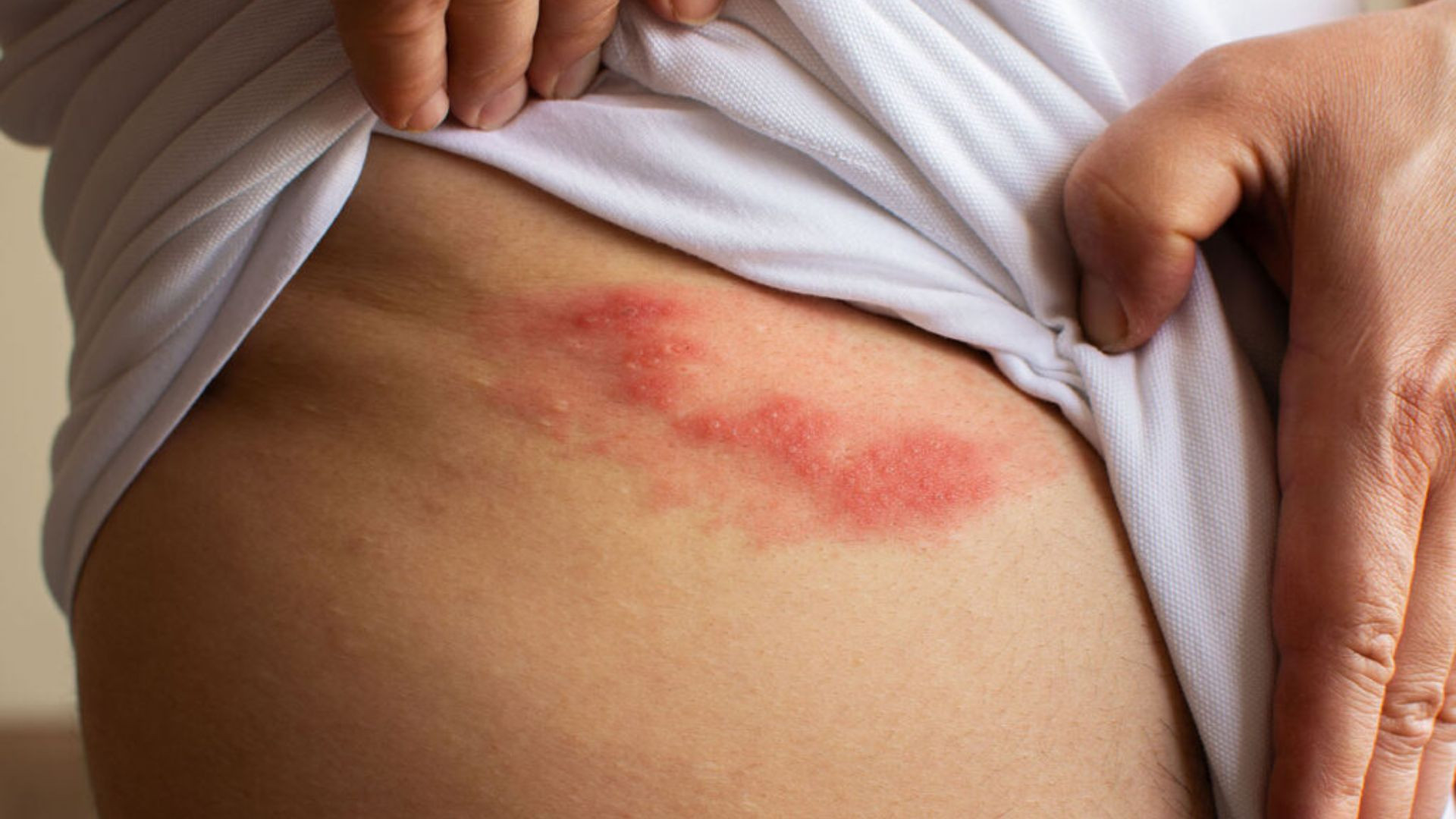 “Giời leo” không đáng sợ, đáng sợ là cơn đau dai dẳng sau khỏi bệnh - Ảnh 1.