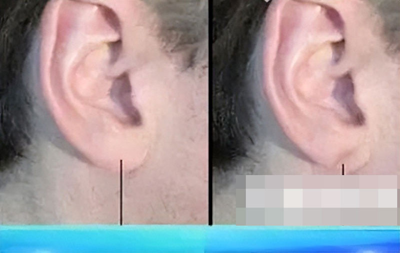 Tắc mạch máu có thể nhận biết qua mặt và chân 6 dấu hiệu không nên bỏ qua