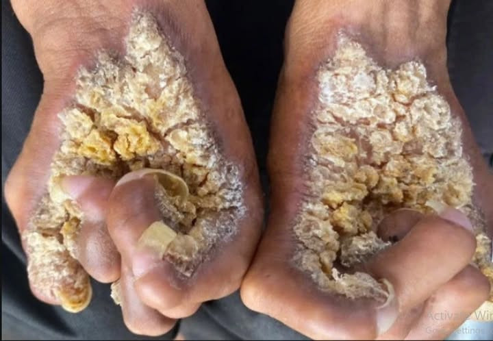 Người đàn ông mắc hội chứng “người cây”, chỉ có 2 người Việt Nam bị - Ảnh 1.