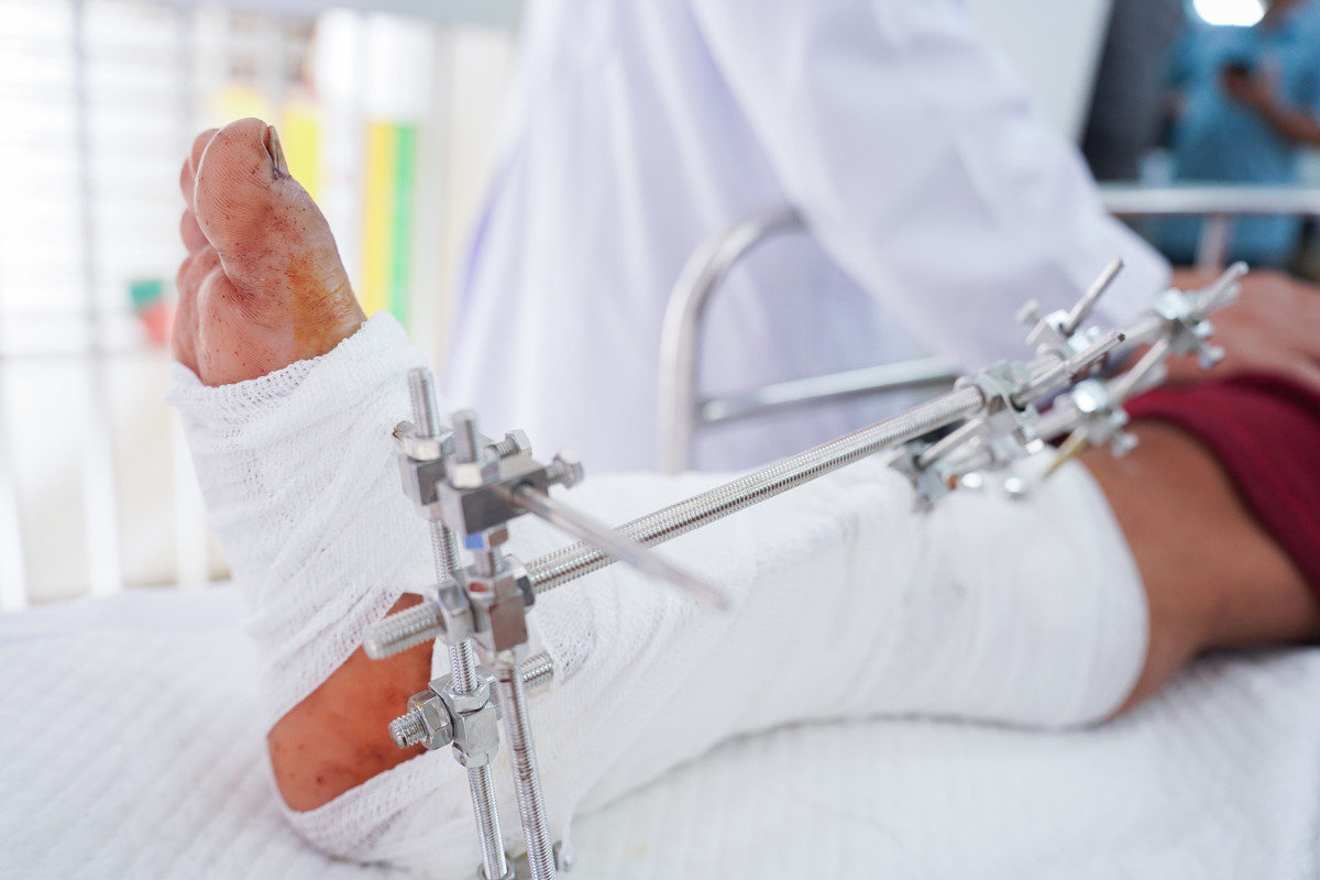 Nối thành công bàn tay của nam công nhân bị chém đứt lìa khi tăng ca đêm插图2 Nối thành công bàn tay của nam công nhân bị chém đứt lìa khi tăng ca đêm插图2