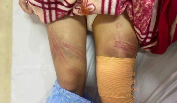 Bé gái bị bầm tím, đang điều trị tại bệnh viện. (Ảnh: CACC)